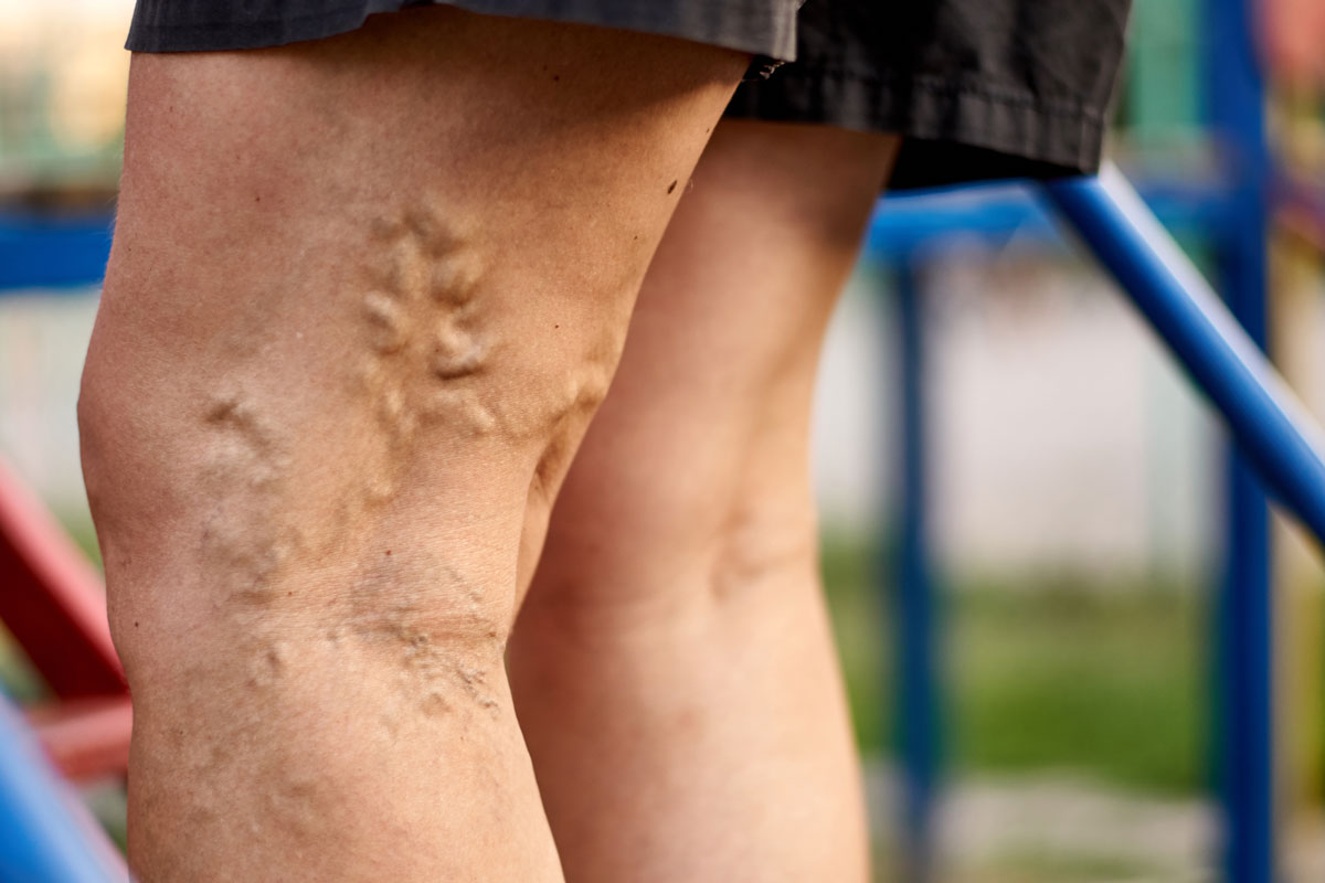 severe-varicose-veins Severe Varicose Veins