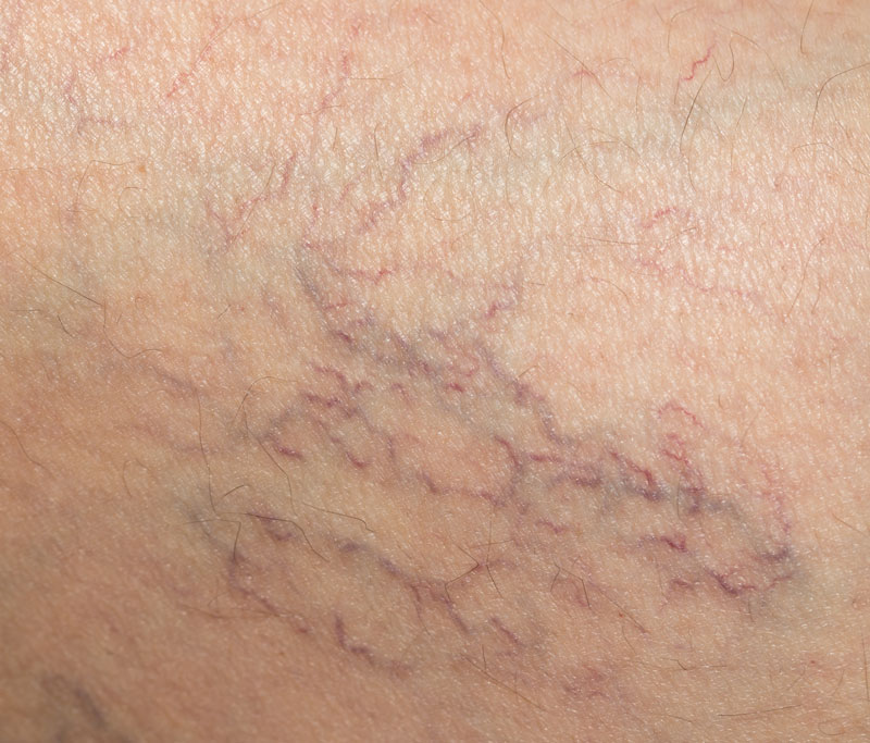 spider-veins-treatment Spider Veins Treatment