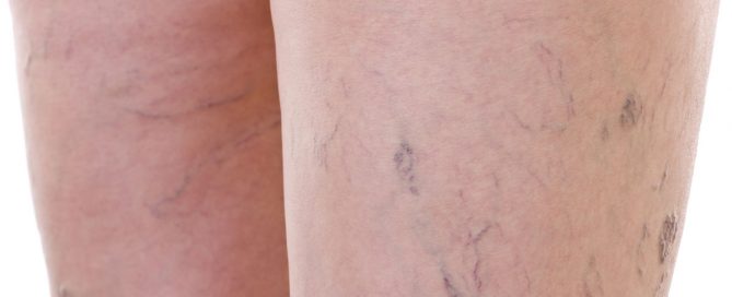 Painful Varicose Veins