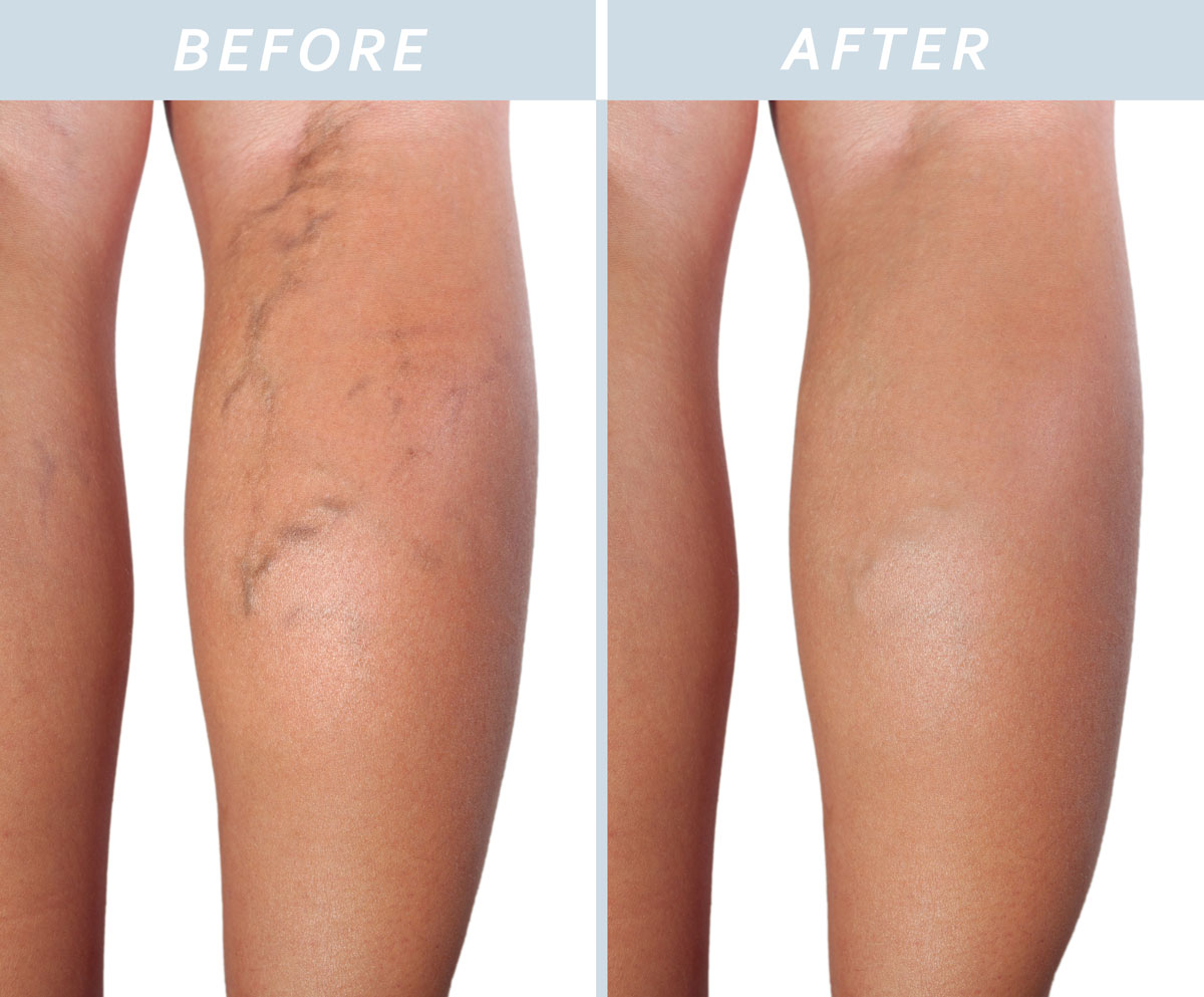 veingogh-treatment VeinGogh Treatment