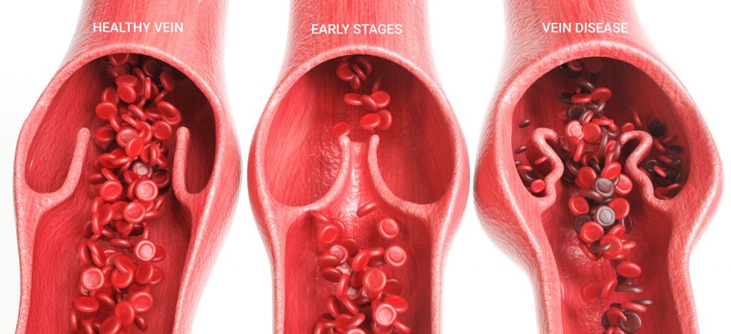 Vein Disease in Vein