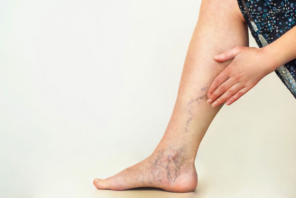 Compression Socks for Varicose Veins
