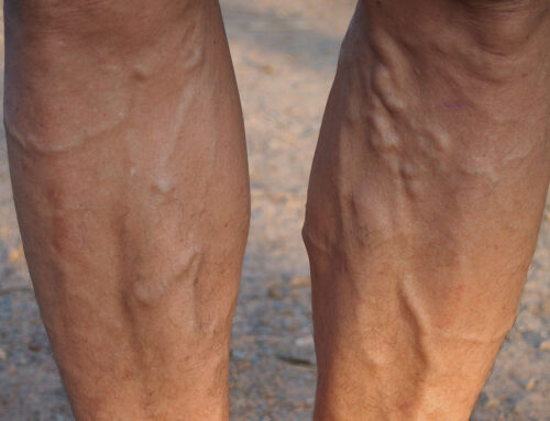 Exploring Endovenous Laser Treatment (EVLT) for Varicose Veins