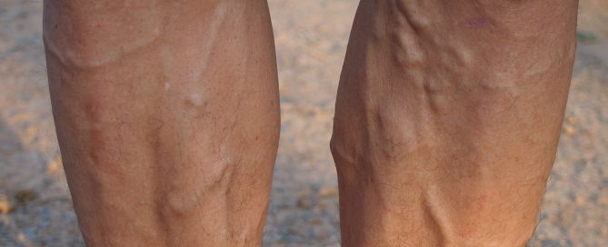 Varicose Veins Men