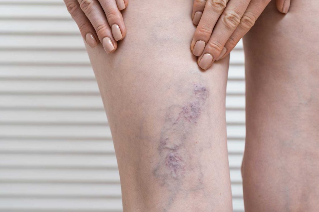 Varicose Veins and Pregnancy