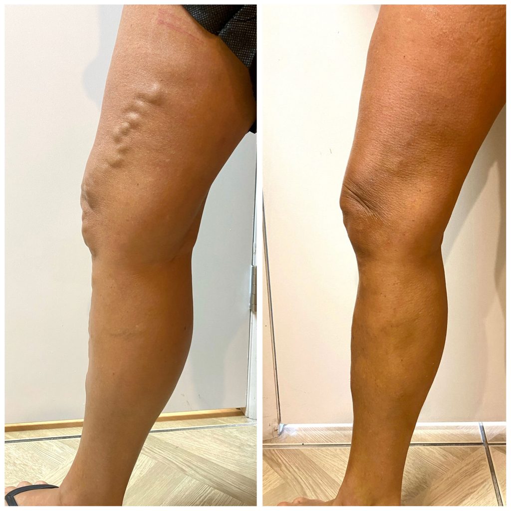 RFA and Ambulatory Phlebectomy of the Great Saphenous Vein