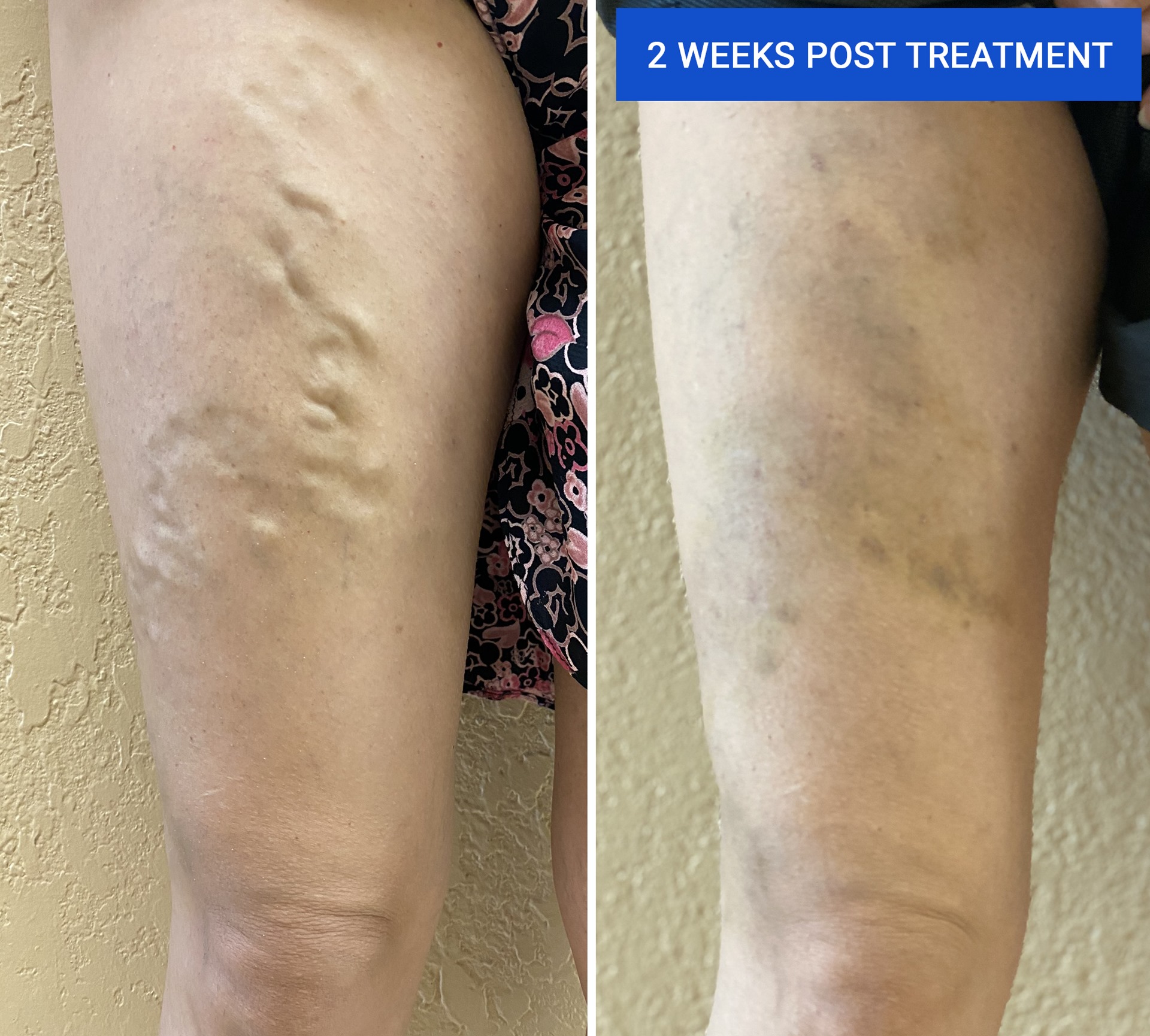 Varicose Veins Treatment