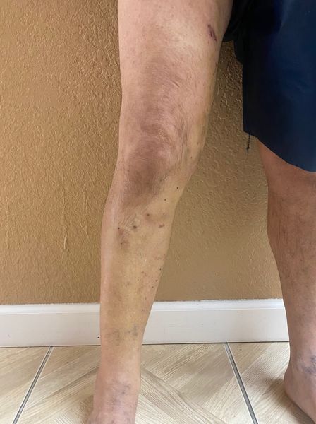 After Varicose Vein Treatment
