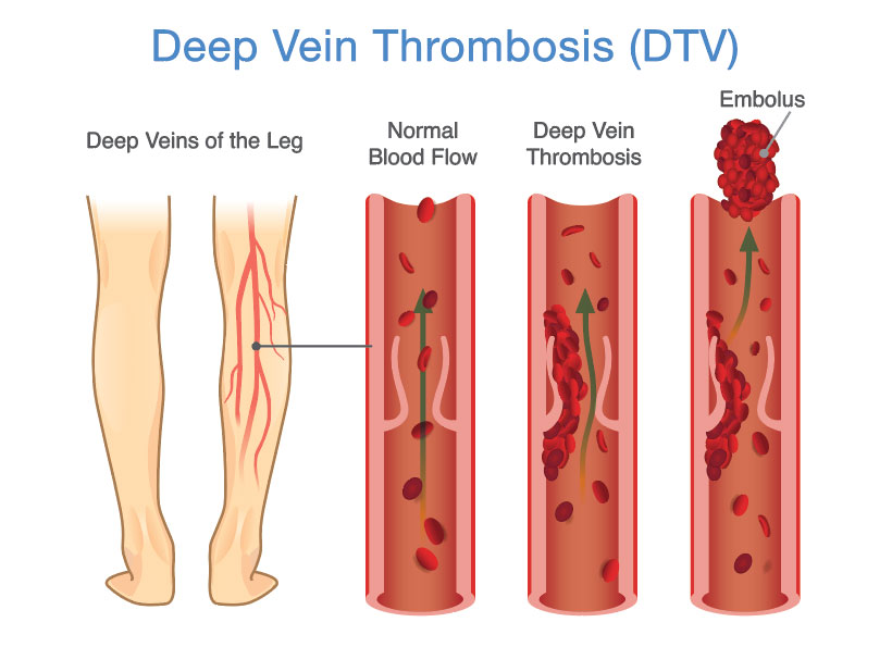 Signs of Blood Clot