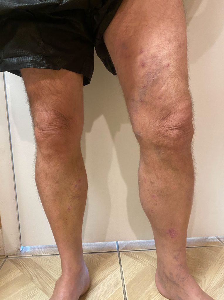 varicose-veins-treatment-after Varicose Veins Treatment After