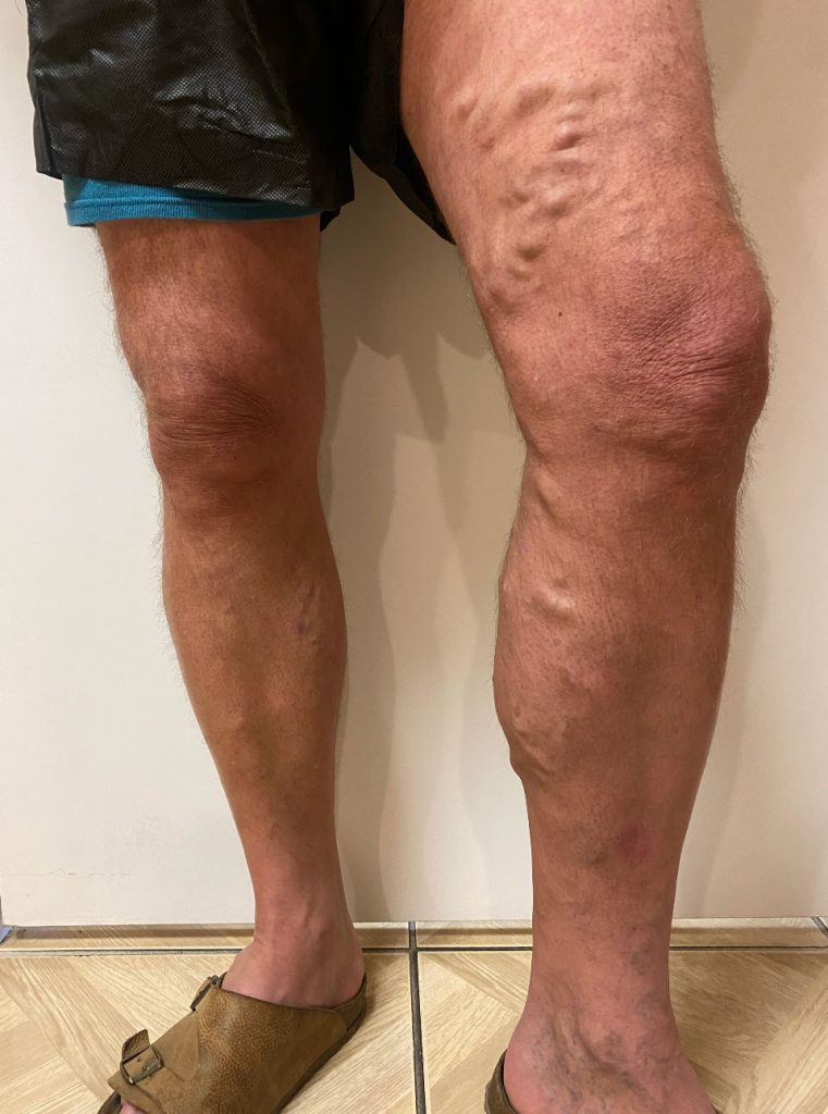 varicose-veins-treatment-before Varicose Vein Treatment Before