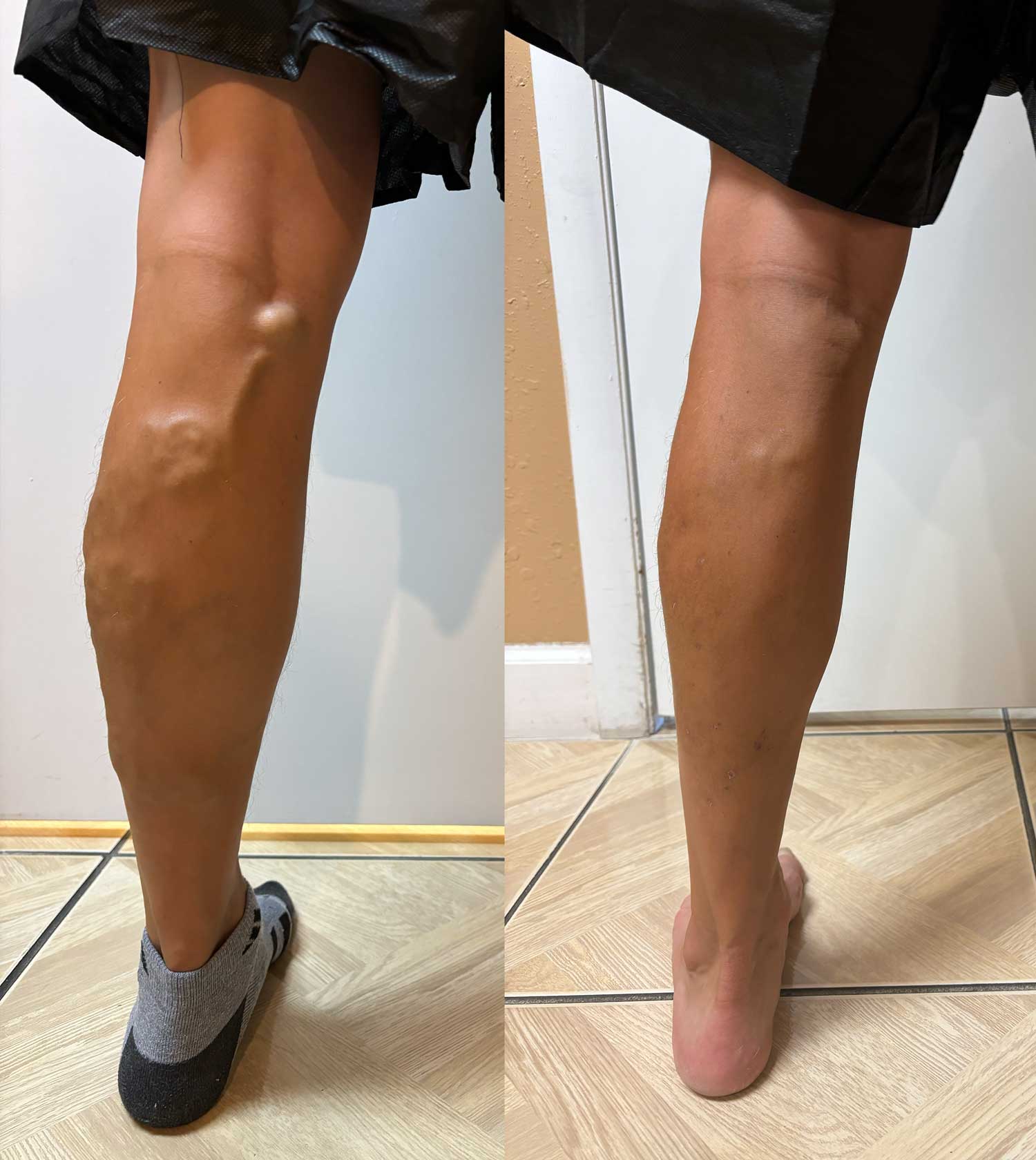 Varicose Vein Removal