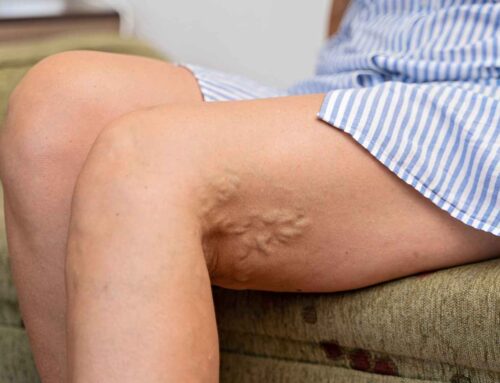 Smoking and Venous Insufficiency