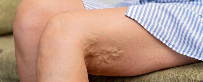 smoking vein disease